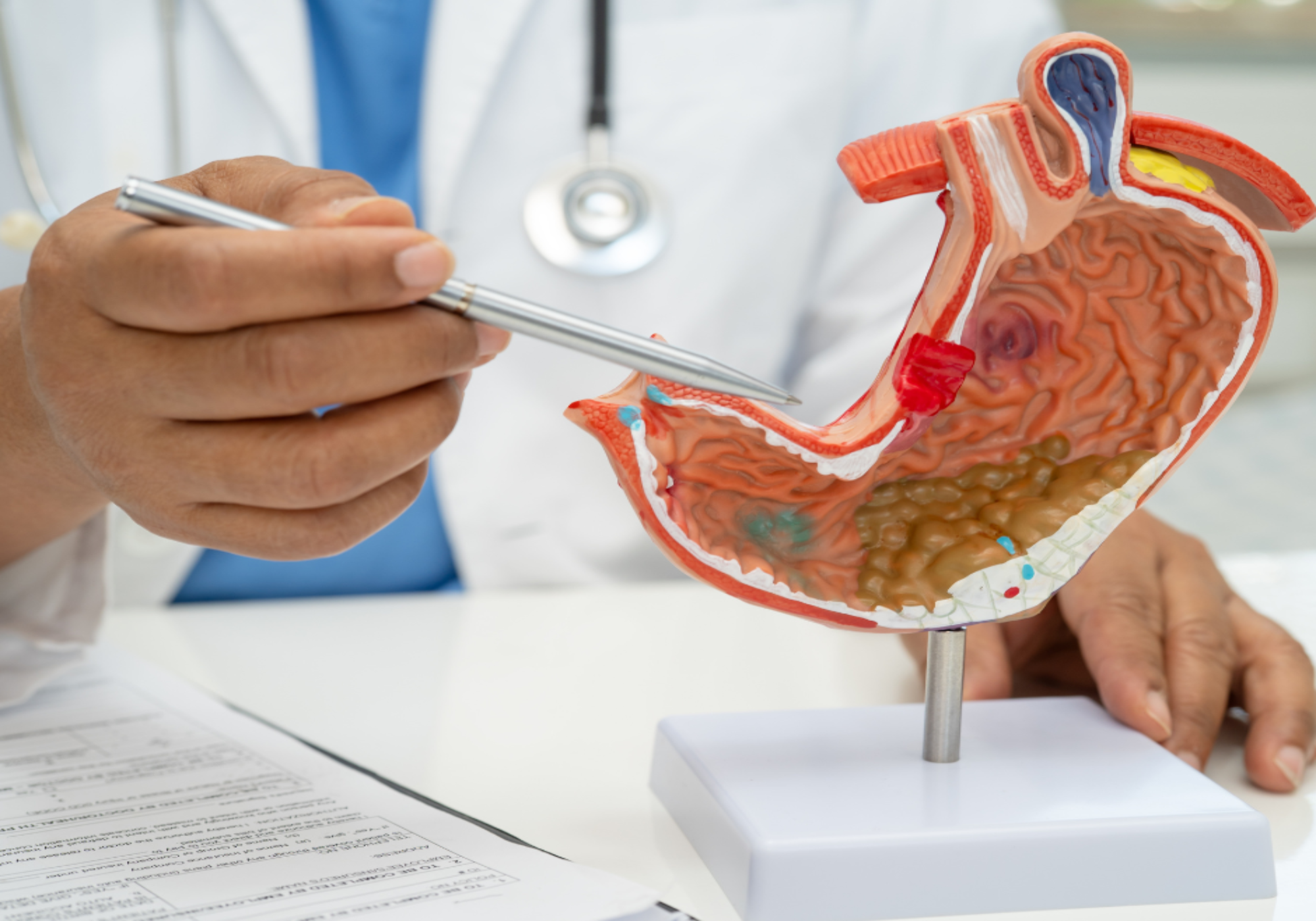 Magengeschwür erkennen und behandeln – Dein Weg zu mehr Wohlbefinden