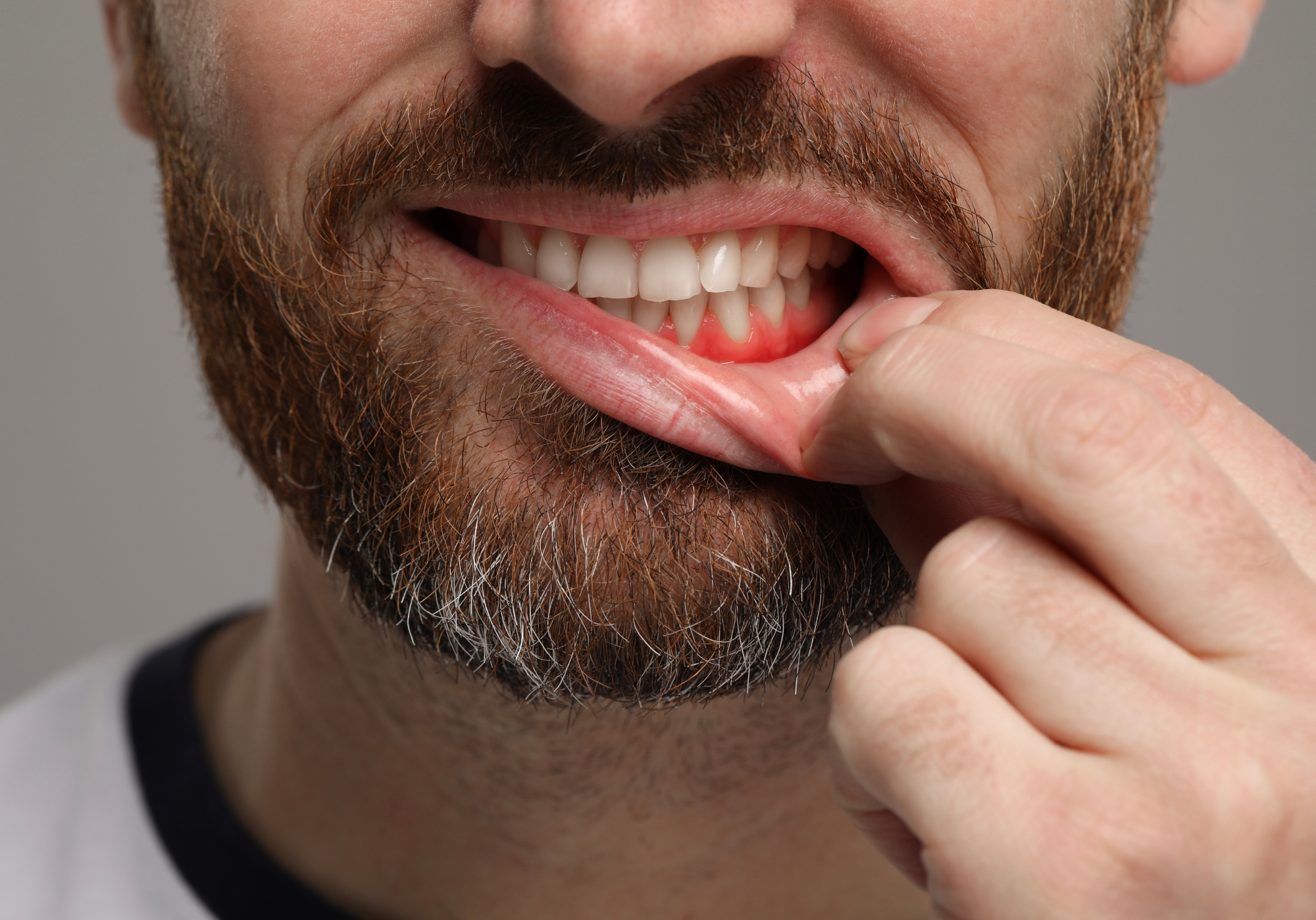 Zahnfleisch blutet beim Zähneputzen – was steckt dahinter?