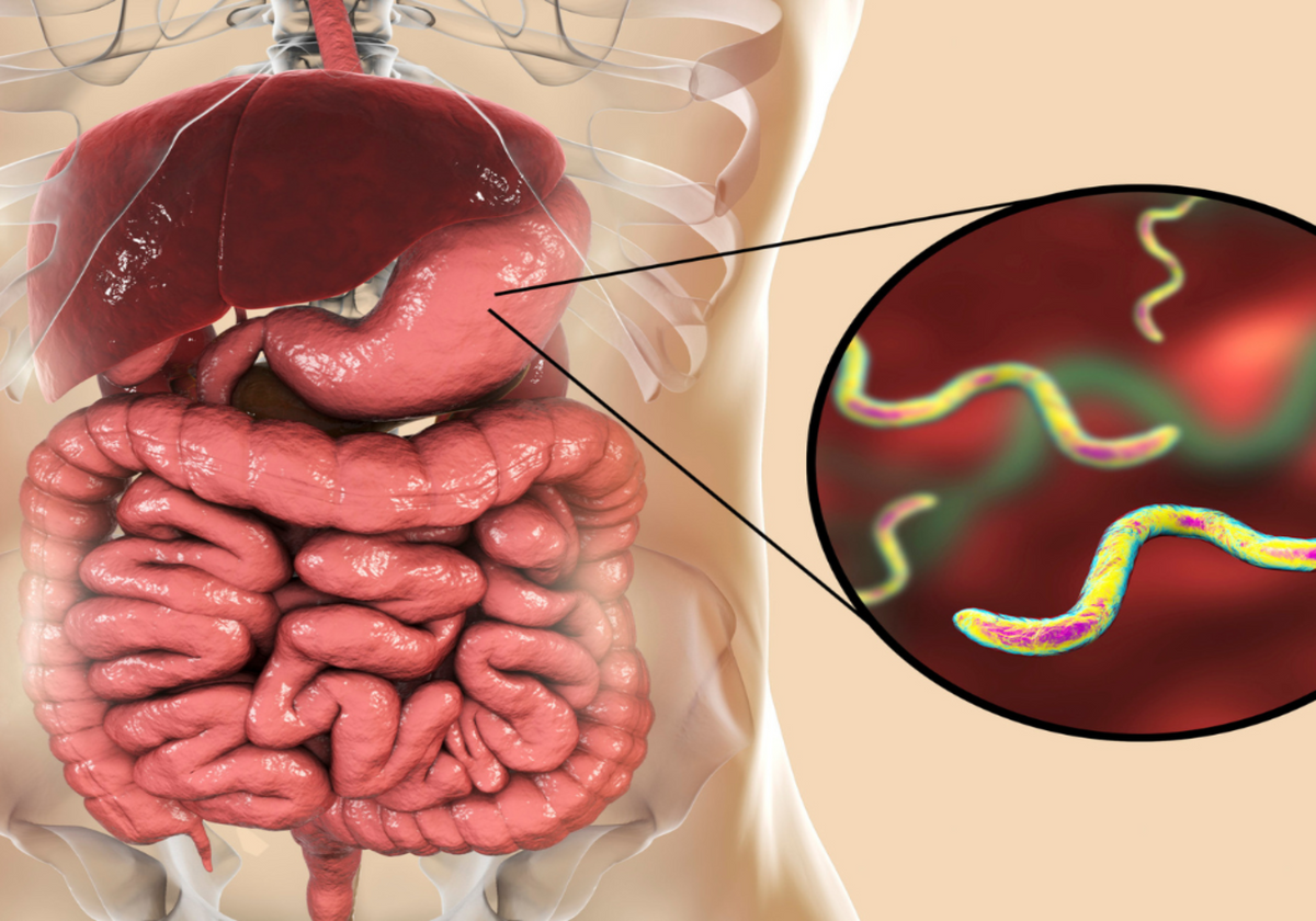 Helicobacter pylori: Ursachen, Symptome und moderne Behandlungsansätze